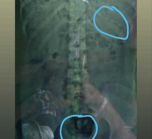 Hasil rontgen bagian dalam tubuh Fitri yang kemasukan jarum.