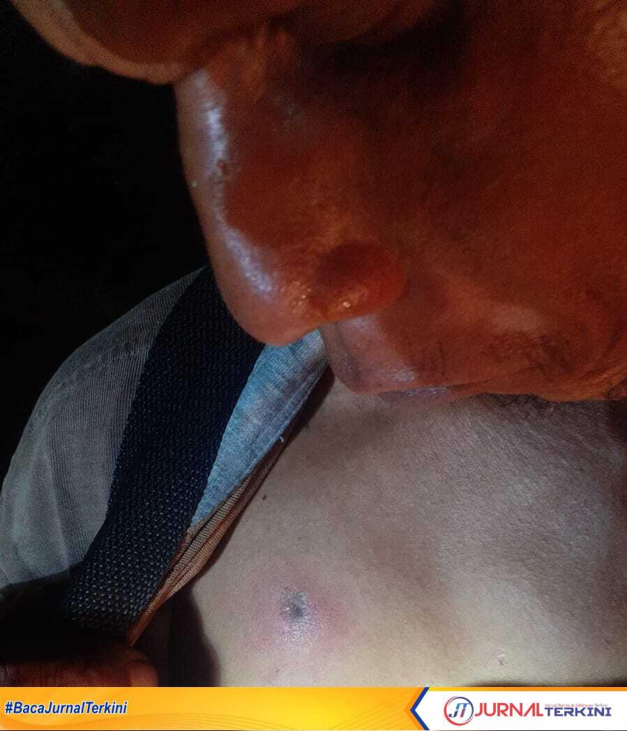 sopir ditembak Sopir truk sawit, Sultan menunjukkan bagian dadanya yang tertembak peluru. (JurnalTerkini.id/alam budi kesuma)