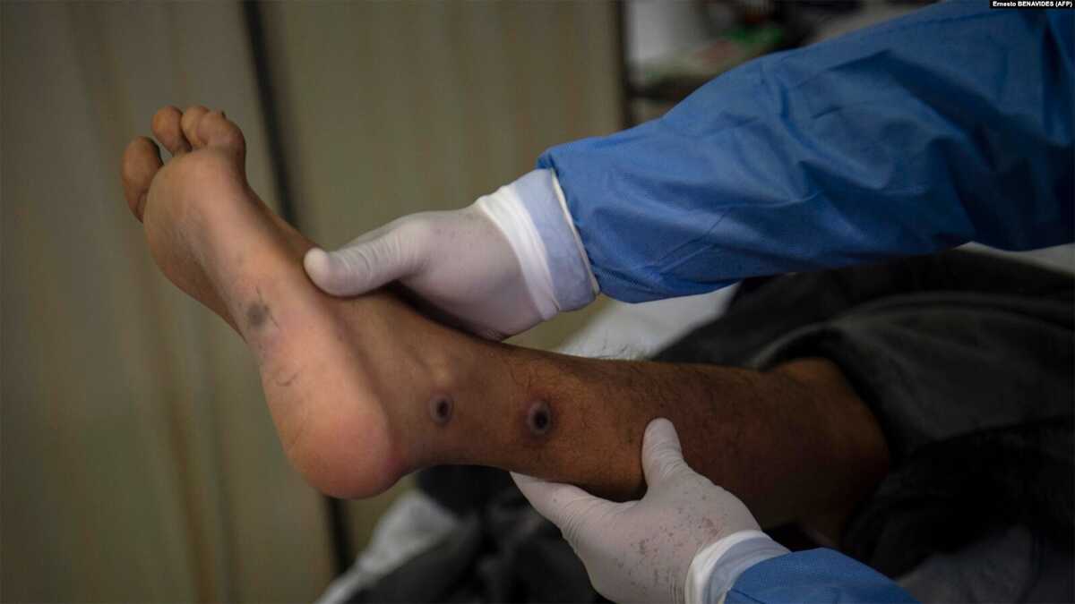 ILUSTRASI - Seorang dokter memeriksa luka pasien akibat terinfeksi cacar monyet (mpox) di ruang isolasi RS Arzobispo Loayza, Lima, 16 Agustus 2022. (AFP/Ernesto BENAVIDES)