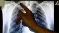 Seorang dokter menunjukkan bagiaan baru-baru yang terinfeksi tuberculosis, London, 17 June 2014. (Foto: Luke MacGregor/Reuters)